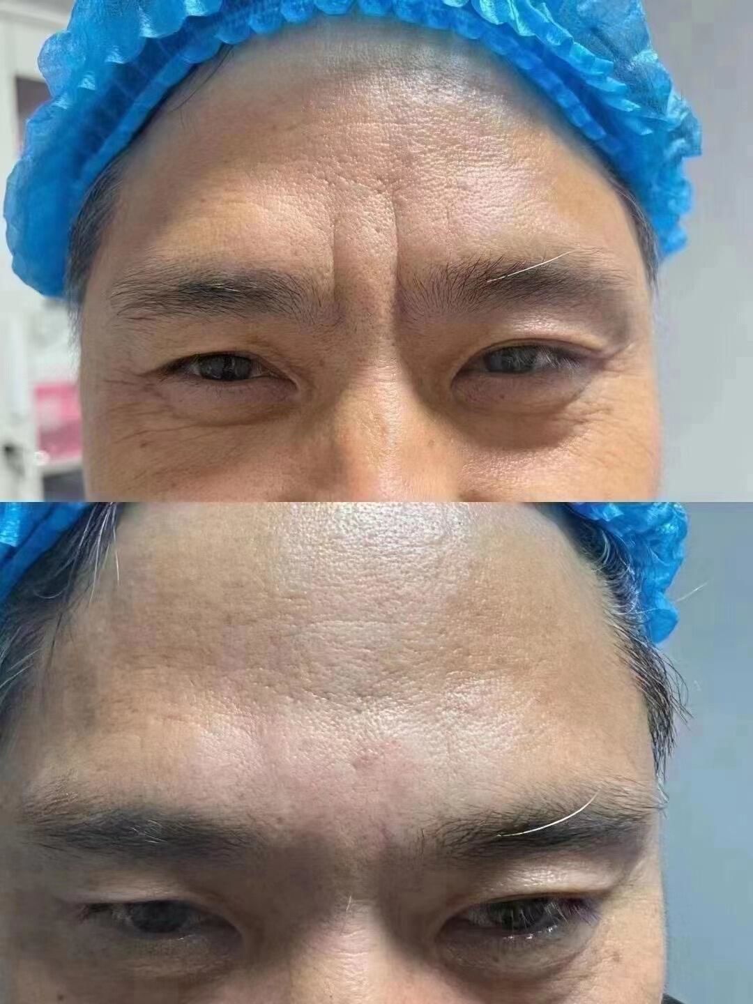 川字纹  抬头纹