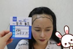 点击看大图 -大麦微针植发丨全国连锁