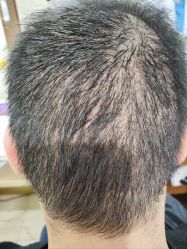 -碧莲盛·不剃发植发