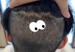 -大麦微针植发全国连锁