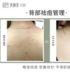 -清颜堂丨分子祛痘·功效美肤