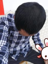 点击看大图 -大麦微针植发丨全国连锁