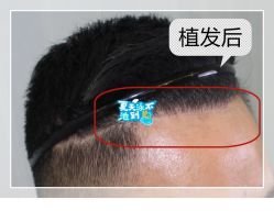 -大麦微针植发全国连锁