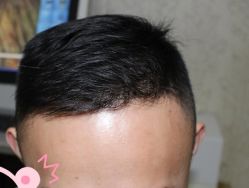 -大麦微针植发丨全国连锁