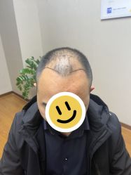 体验前-大麦微针植发全国连锁