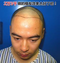 -碧莲盛·不剃发植发