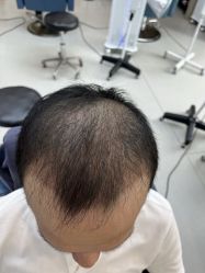 -大麦微针植发全国连锁