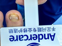 -Andrew指甲专科灰指甲·甲沟炎矫正·3D步态矫形鞋垫定制(浦三路店)