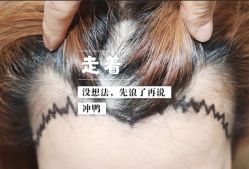 -大麦微针植发全国连锁