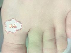 -祖传修脚甲沟炎灰指甲鸡眼
