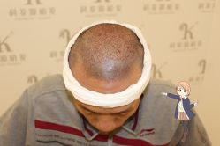 -大麦微针植发丨全国连锁