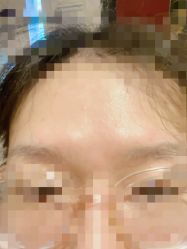 体验后-四川娇点医学美容医院