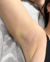 -薇兰专业脱毛连锁机构