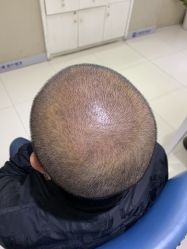 体验后-大麦微针植发全国连锁