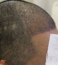 -大麦微针植发丨全国连锁