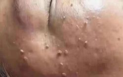 -瑶芳清颜草本祛痘