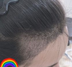 -大麦微针植发丨全国连锁