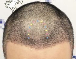 -大麦微针植发全国连锁