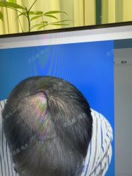 -碧莲盛·不剃发植发