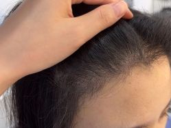 -大麦微针植发全国连锁