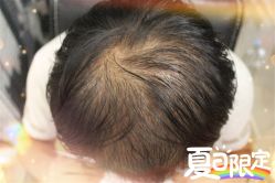 -大麦微针植发全国连锁