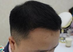 -大麦微针植发丨全国连锁