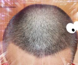 -大麦微针植发全国连锁