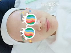体验后-时光海科学美肤中心