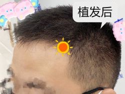 -大麦微针植发全国连锁