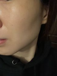体验后-西安壹加壹医疗美容·西北抗衰旗舰店