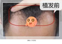 -大麦微针植发全国连锁