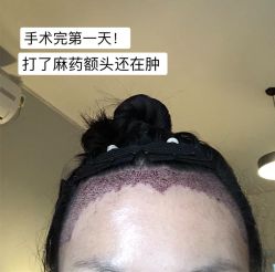 -碧莲盛·不剃发植发
