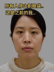 -广州健丽·去眼袋医疗美容机构