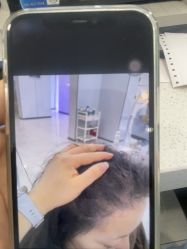 -大麦微针植发丨全国连锁