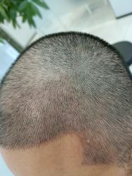 -大麦微针植发丨全国连锁