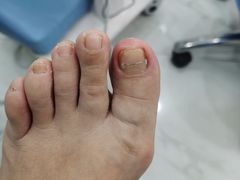 -Andrew指甲专科灰指甲·甲沟炎矫正·3D步态矫形鞋垫定制(浦三路店)