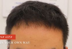 -大麦微针植发全国连锁