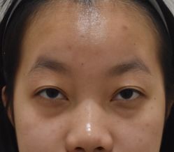 体验前-广州健丽·去眼袋医疗美容机构