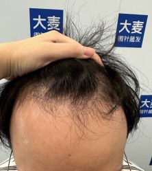 -大麦微针植发全国连锁