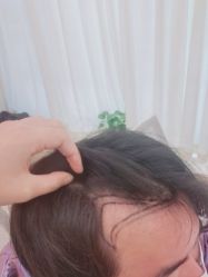 -碧莲盛·不剃发植发