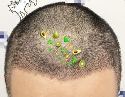 -大麦微针植发全国连锁