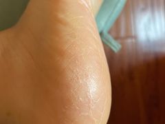 -世龙世家灰指甲·甲沟炎·跖疣护理·修脚(东江湾路店)
