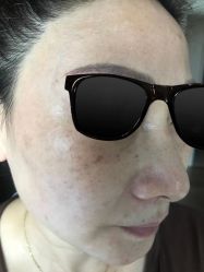 -爱莎扁平疣·汗管瘤·斑痣中心