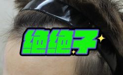 -大麦微针植发丨全国连锁