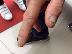 点击看大图 -德哥灰指甲脚气甲沟炎跖疣护理