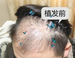 -大麦微针植发全国连锁