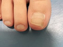 -世龙世家灰指甲鸡眼脚气甲沟炎跖疣护理(通州店)