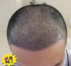 -大麦微针植发丨全国连锁