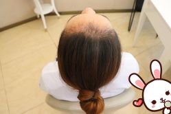 -大麦微针植发丨全国连锁