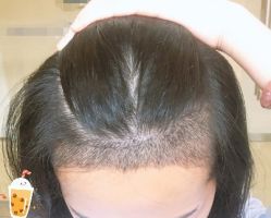 -大麦微针植发丨全国连锁